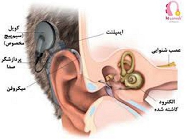 ۲۹۲ عمل کاشت حلزون شنوایی در استان همدان ۲۹۲ عمل کاشت حلزون شنوایی در استان همدان