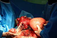 جراحی موفق توده ۴ کیلویی در بابل
